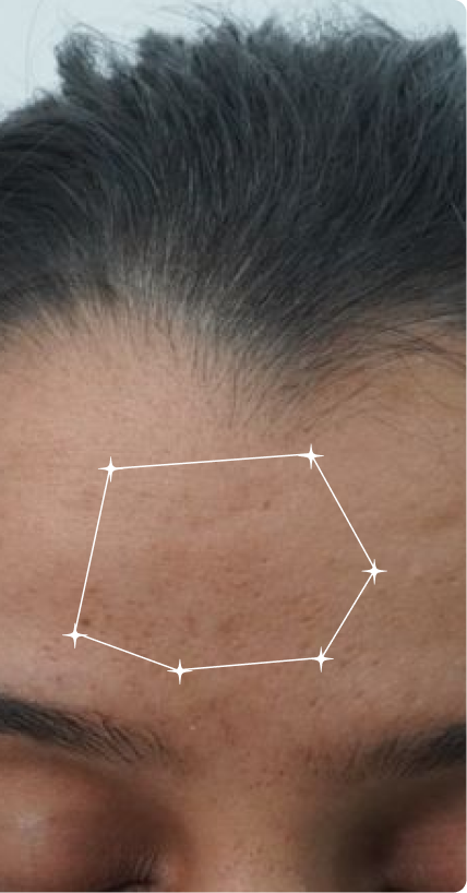 After — Dark Spots