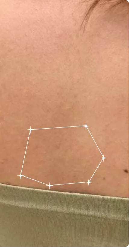 After — Chest Acne