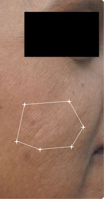After — Pigmentation