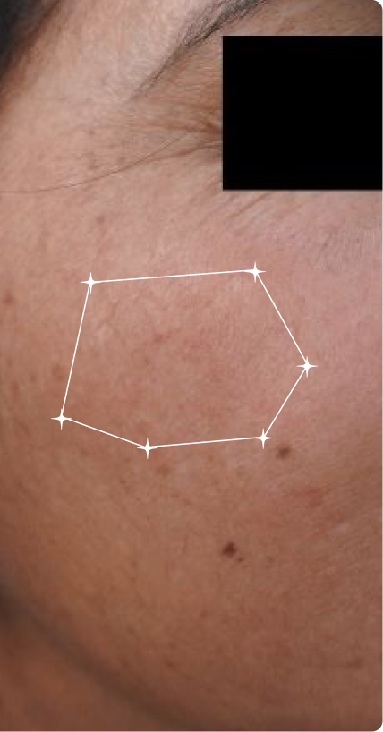 After — Melasma