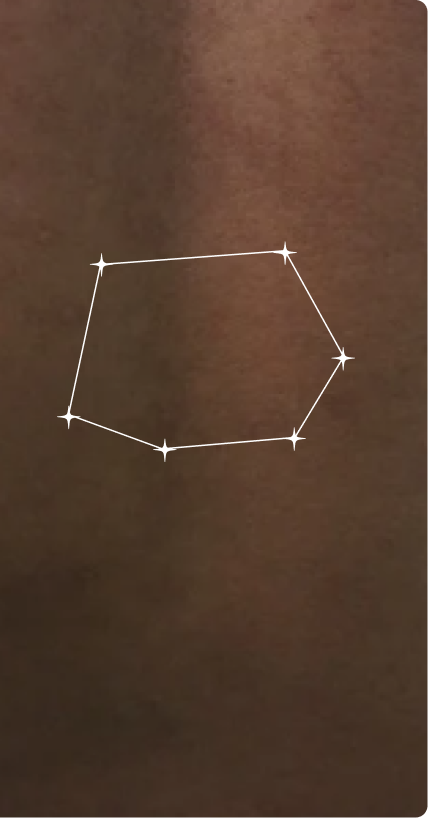 After — Body Acne