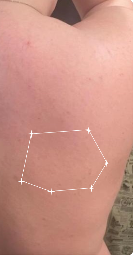 After — Back Acne