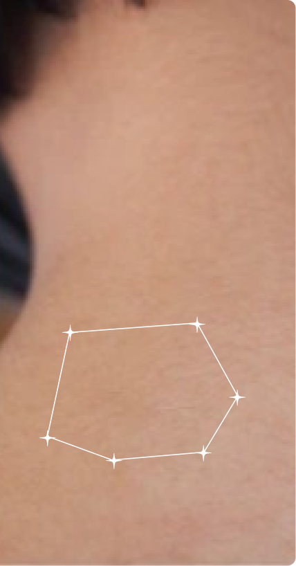 After — Post-Acne Marks