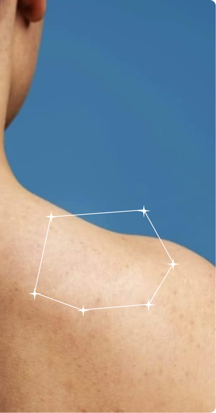 After — Shoulder Acne