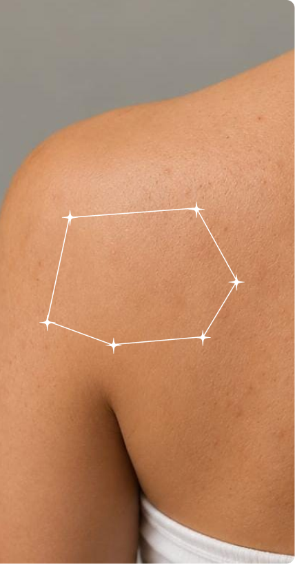 After — Body Blackheads
