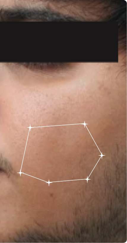 After — Pigmentation
