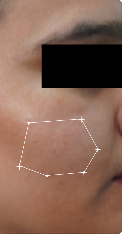 After — Open pores