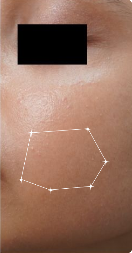 After — Oily Skin